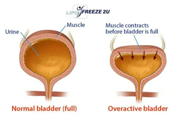 diagram of overactive bladder treatment Corby