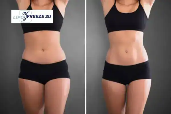 How Can LIPO FREEZE 2U Support Your Post-Pregnancy Body Recovery Corby?
