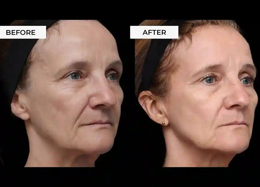 How Many RF Microneedling Sessions Will You Need to See a Difference Corby?