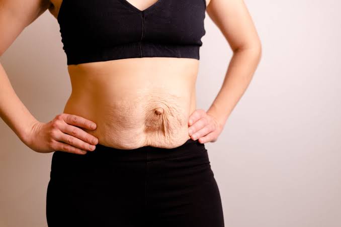 Is Surgery Really the Only Way to Repair Diastasis Recti Corby?
