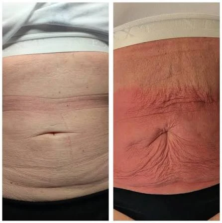 How Does RF Microneedling Improve Crepey, Thin and Uneven Skin Texture Corby?