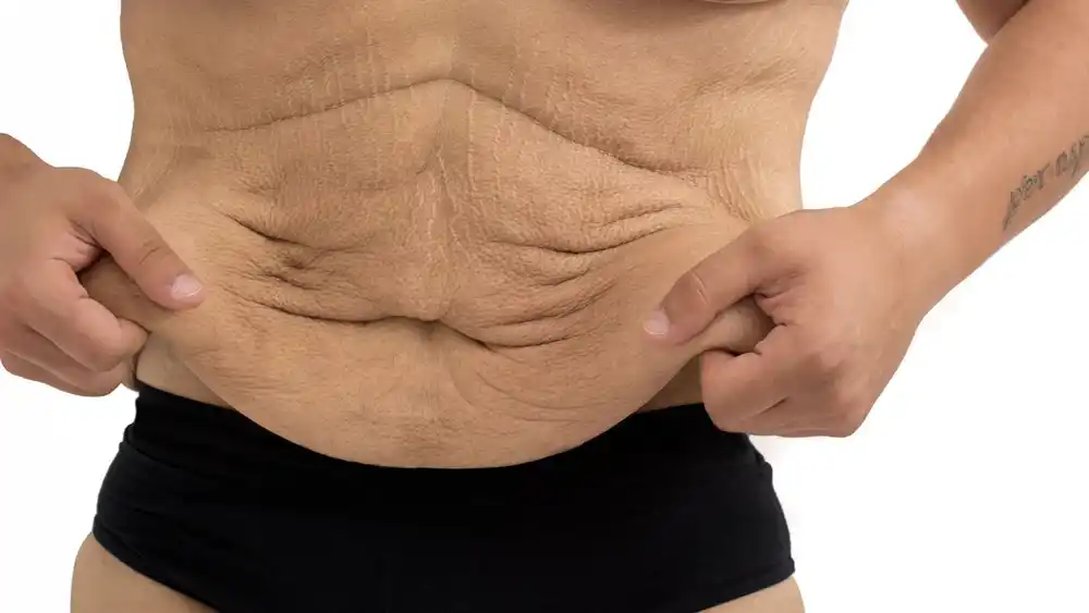 Why Does Weight Loss Medication Leave Some People With Loose or Sagging Skin Corby?